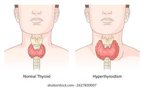 Thyroid Disorder